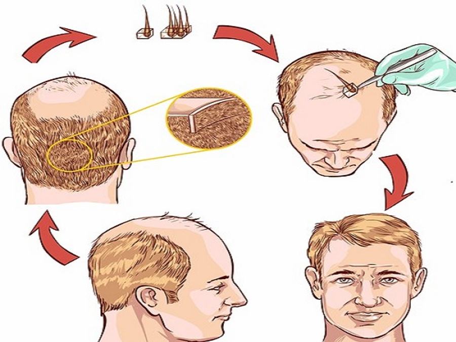 hair transplant