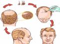 Panacea Global, Completed 5000+ Hair Transplant Procedures Successfully