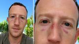 Mark Zuckerberg Uploads Selfie With Bruises On His Face. Here's What Happened