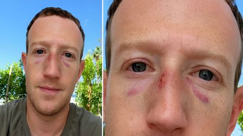 Mark Zuckerberg Uploads Selfie With Bruises On His Face. Here's What Happened
