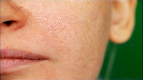 Is it Possible to Get Rid of Acne Overnight?