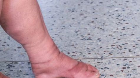 UP को फाइलेरिया मुक्‍त बनाने के लिए शुरू किया गया मिशन, 10 से 28 फरवरी चलाया जाएगा अभियान