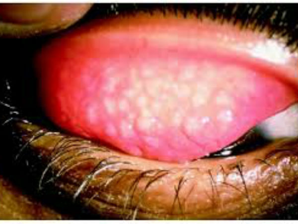  டிரக்கோமா 