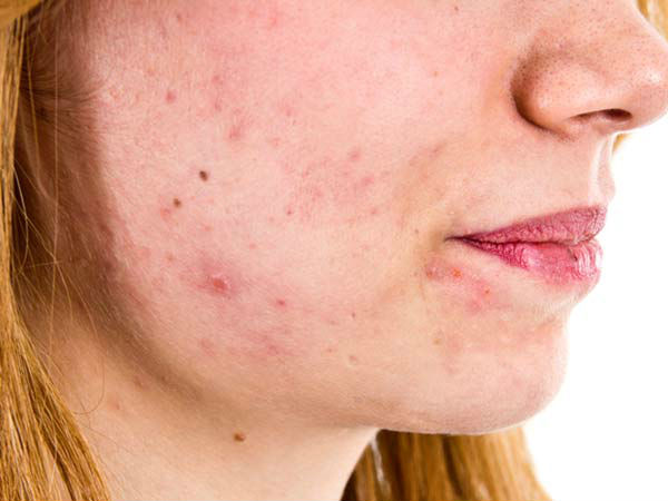 பக்க விளைவுகள்