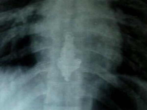 எக்ஸ் ரே 