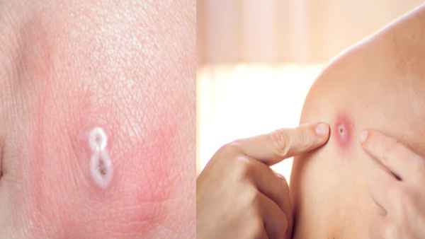  குரங்கு அம்மை நோய்க்கு காப்பீடு உண்டா? 