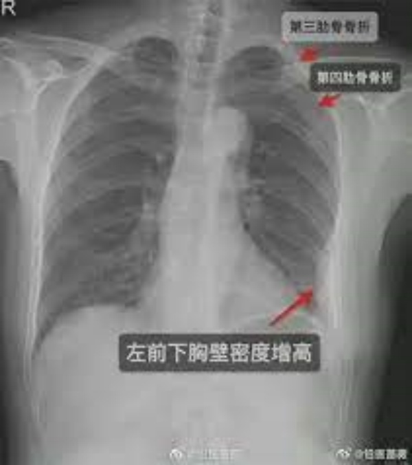 கட்டிப்பிடித்ததால் காயம்