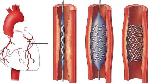 இளம் தலைமுறையினரை பயமுறுத்தும் இதய பாதிப்புகள் - கோவை மருத்துவர் திருவேங்கடம் விளக்கம் 