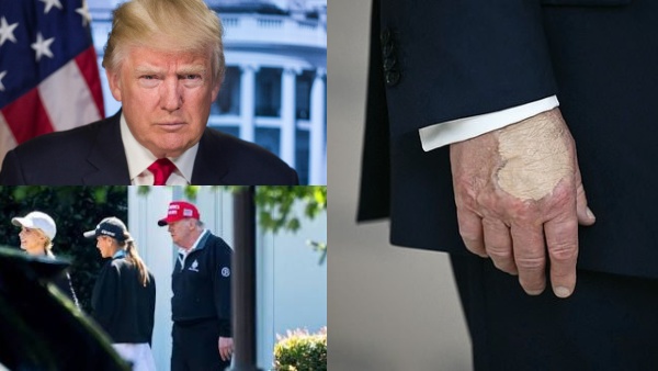 டிரம்புக்கு இருக்கும் உடல்நல பிரச்சினை.. கவனிக்க தவறினால் கால்களை அகற்ற நேரிடும் - மருத்துவர்கள்