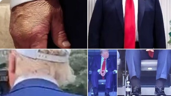 டிரம்புக்கு இருக்கும் உடல்நல பிரச்சினை.. கவனிக்க தவறினால் கால்களை அகற்ற நேரிடும் - மருத்துவர்கள்