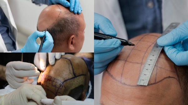 உயிரை பறிக்கும் Hair Transplant சிகிச்சைகள்!! சாட்டையை கையில் எடுத்த மத்திய அரசு!!